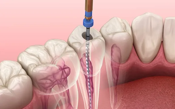 Endodoncia