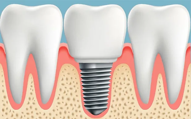 Implantes Dentales