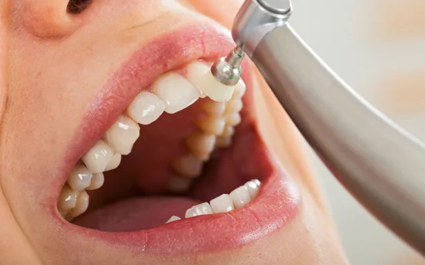 Limpiezas Dentales